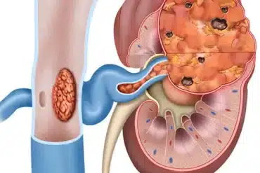 Kidney Cancer Symptoms