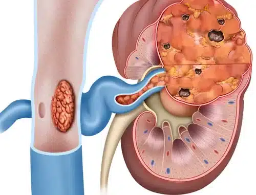 Kidney Cancer Symptoms