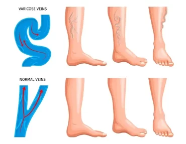 Varicose_veins