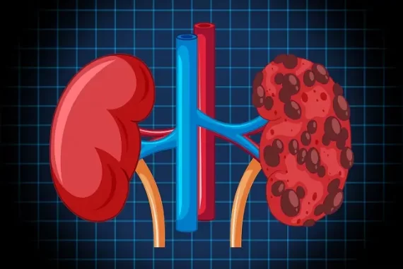 renal disease